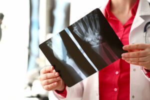 Understanding Broken Bones