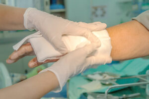 How Are Burns Typically Classified?