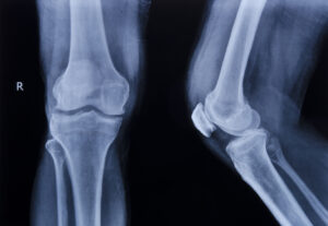 What Is a Rotator Cuff Injury?